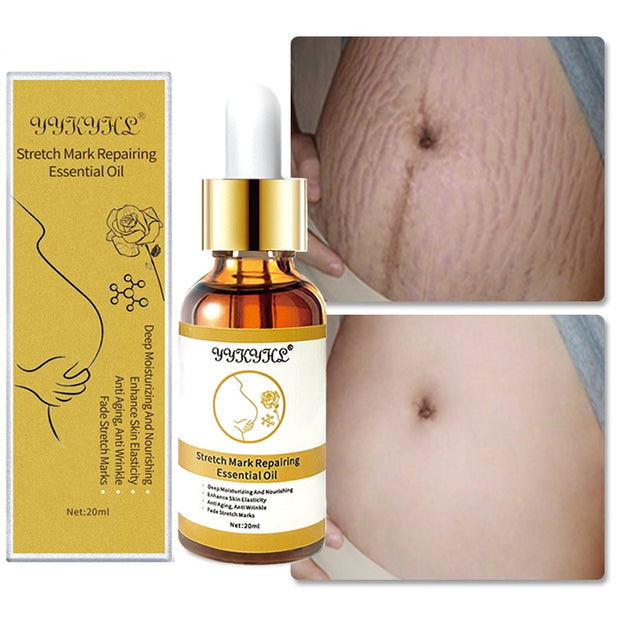 Stretch Marks Remover Essential Oil Skin Care Treatment Cream Maternity Repair Anti-Aging Anti-Winkle Firming Anti-Slackline Oil